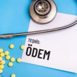 ödem